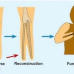 krukenberg procedure